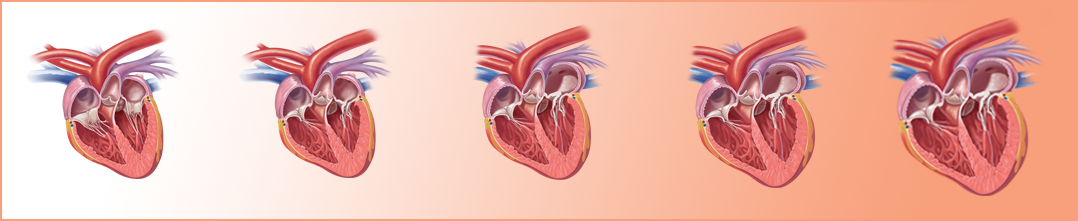 Stages of heart disease